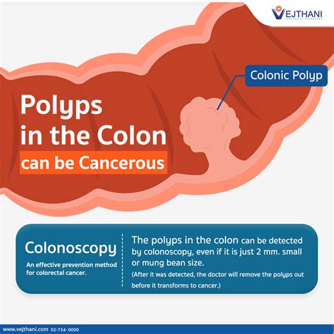 laboratory for analysis colon cancer|treatment for cancerous colon polyps.